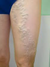 Varicose Veins Originating In The Pelvic Region Pelvic Venous Congestion Syndrome San Diego Vascular Center