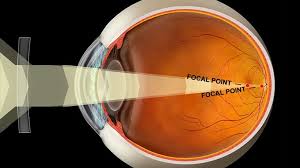 Image result for Refractive Error