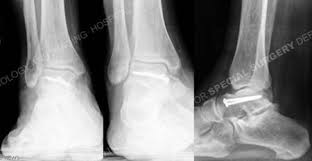 Image result for Talus Fracture