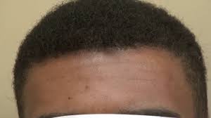 This creates a hairline which is caving upwards towards the back of my head. Hair Transplant Pioneer Dr Diep Shows Hair Loss Procedure Results Performed On An African Hair Growth For Men Hair Loss Remedies Women What Causes Hair Loss