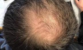 Reverse your thyroid hair loss. Scientists Develop New Technique To Reverse Balding By Transplanting Hair Cells Into The Scalp Daily Mail Online