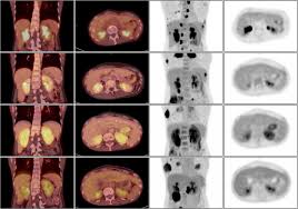 Check spelling or type a new query. Positron Emission Tomography As An Adjuvant Diagnostic Test In The Evaluation Of Checkpoint Inhibitor Associated Acute Interstitial Nephritis Journal For Immunotherapy Of Cancer Full Text