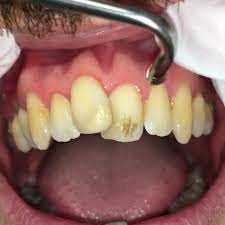 How To Remove Teeth Stains Video Stained Teeth Dental Videos Teeth Stain Remover