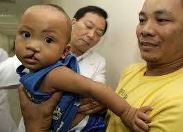 Filipino Child Deformity Mark Carlos Nuegas Editorial Stock Photo