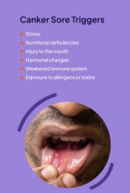 Image result for Mouth ulcers symptoms roof of the mouth