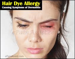 Coconut oil is widely used as a remedy for skin irritation. How Long Does Hair Dye Allergy Last And How To Avoid Getting Allergy To Hair Dye