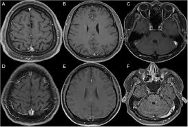 Clippers syndrome (chronic lymphocytic inflammation with pontine perivascular enhancement responsive to steroids) is a recently described rare disease affecting the central nervous system. Clippers Syndrome A Case Report In A Chinese Patient With Juxtacortical Lesions Multiple Sclerosis And Related Disorders