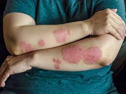 Watch a video, review additional information, and test your knowledge of the moa for otezla (apremilast) for adults with moderate to severe plaque psoriasis. Reasons Why Your Psoriasis Treatment Isn T Working