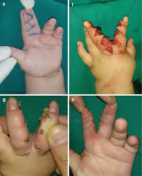 Image result for Syndactyly