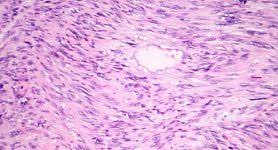 Image result for Leiomyosarcoma