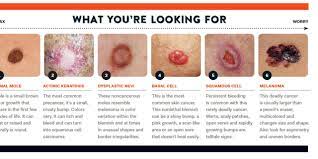 The early stage disease was confirmed for the detected melanoma and skin cancer. We Re In Trouble Skin Cancer Is On The Rise And Not Just For Golfers Golf Digest