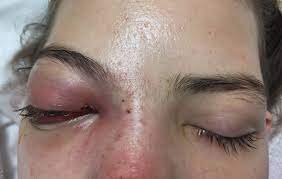 Lethargy and vision loss: successful management of rhinocerebral mucormycosis | BMJ Case Reports