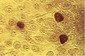 Image result for Chlamydia Trachomatis