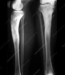 Image result for Osteomyelitis