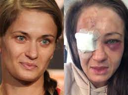 Maybe you would like to learn more about one of these? Tak Bedzie Wygladala Operacja Karoliny Kowalkiewicz Wszczepia Jej Tytanowa Blaszke Super Express