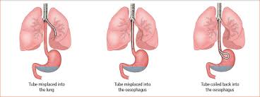 Sometimes the tube is passed into the small intestine to allow enteric feeding. How To Insert A Nasogastric Tube And Check Gastric Position At The Bedside