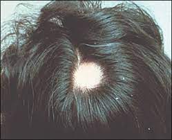 Treatment can prevent hair loss from worsening and help women regrow their hair. Alopecia In Women American Family Physician