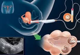 Ask for detailed information about the costs associated with each step of the procedure. How Does Egg Donation Work Asc Egg Donation California
