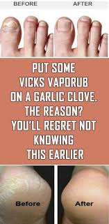 Vicks Vaporub Has Been Used For Treating Headaches Cold Cough Congested Nose Chest And Throat Stuffiness However V Vicks Vaporub Vicks Infographic Health