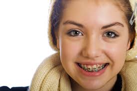 May 17, 2021 · if you're wondering what are some cute colors for braces, or what colors look best on braces in general, the answer is likely to change from person to person. 5 Signs Your Child Can Benefit From Braces Mom Does Reviews