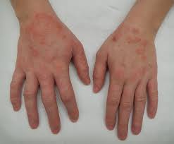 Image result for dermatitis contacta children