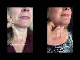 Jack Zamora MD J-Plazty Face Lower Face