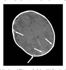 Image result for CT Head