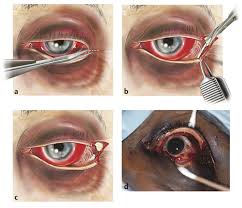 Image result for Lateral Canthotomy