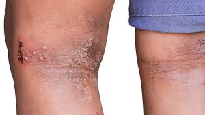 Image result for Skin Infection