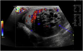 Because an elevated tumor marker doesn't necessarily indicate cancer, tumor markers cannot be used alone to diagnose cancer. Tumour Markers And Their Utility In Imaging Of Abdominal And Pelvic Malignancies Sciencedirect