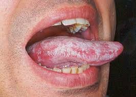 Aceasta apare atunci celulele moarte, bacteriile sau particulele de decolorare sunt raman pe limba si. Candidoza Vaginala Si Bucala Cauze Simptome Tratament Poze