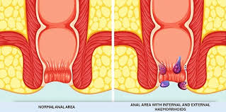 Image result for hemoroid human