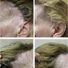 You may need to take propecia for up to 3 months before you see a benefit, although the best results may take up to 12 months to appear for some men. Pdf Finasteride Mediated Hair Regrowth And Reversal Of Atrophy In A Patient With Frontal Fibrosing Alopecia