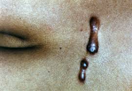 Check spelling or type a new query. Keloids Harvard Health