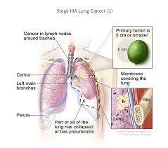 But lung cancer also occurs in people who never smoked and in those who never had prolonged lung cancer often spreads (metastasizes) to other parts of the body, such as the brain and the begin conversations about the dangers of smoking with your children early so that they know how to. Lung Cancer Staging Virginia Oncology