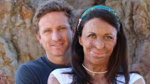 Meski Luka Bakar Hancurkan Wajah Istrinya, Cinta Michael Hoskin Tak  Berkurang Sedikitpun