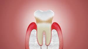 10 amazing foods to strengthen teeth. Can Receding Gums Grow Back Corsodyl
