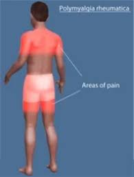 Image result for Polymyalgia Rheumatica