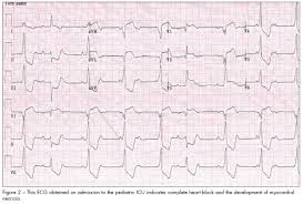 Ecg changes in acute pericarditis, myocarditis, perimyocarditis. Myocarditis With Complete Heart Block Challenges In Diagnosis And Treatment Consultant360