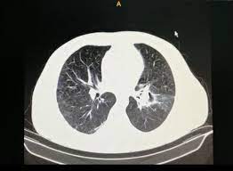 Presentamos el caso de una mujer de 34 años de de una mucormicosis primaria (rinocerebral, pulmonar o gastrointestinal). La Nlrisyqmham