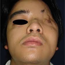 Hypoplasia in the left frontotemporal area.