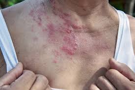 Image result for shingles