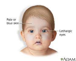 Shaken Baby Syndrome Medlineplus Medical Encyclopedia