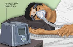 Image result for Obstructive Sleep Apnea