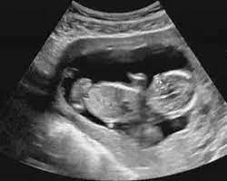 14 Semanas De Gravidez