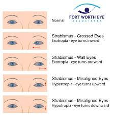 Strabismus Surgery For Misaligned Eyes, Crossed Eyes, Or Wall Eyes