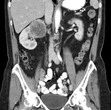 Kidney cancer represents about 3.7 percent of all cancers in the united states. Renal Cell Carcinoma Oncology Medbullets Step 2 3