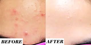 Emuaid.com has been visited by 100k+ users in the past month This Retinol Before And After Acne Treatment On Reddit Is Going Viral