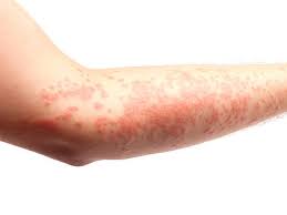Allergy And Asthma Associates How Do You Get Rid Of An Allergic Reaction Rash Hunterdon Pulmonary Sleep
