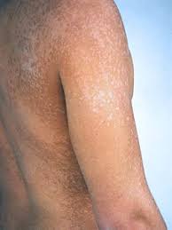 What is tinea versicolor ? Tinea Versicolor